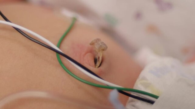 Closeup of Newborn Babys Umbilical Cord Stump