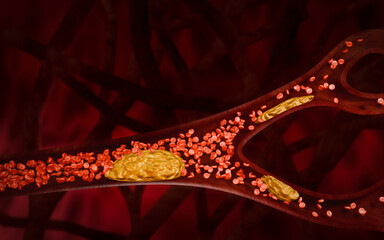 Hyperlipidemia or arteriosclerosis. Blocked artery concept and human blood vessel as a disease with cholesterol fat buildup clogging. Clogged arteries, Cholesterol plaque in the artery. 3D Rendering