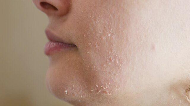 Close up capturing woman gently touching dry, irritated facial skin, highlighting sensitive dermatological skincare texture and complexion issue