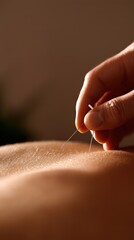 Hand Inserting Acupuncture Needle On Skin For Alternative Therapy Treatment