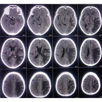 CT scan of brain, Intraventricular hemangioma with adjoining periventricular seepages and herniation.