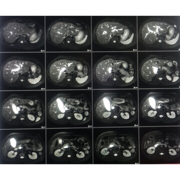 MRCP film of MRI of abdomen. Hepatic parenchymal tiny calcification, hepaticolithiasis. Liver, bile duct, pancreas duct for medical health diagnosis