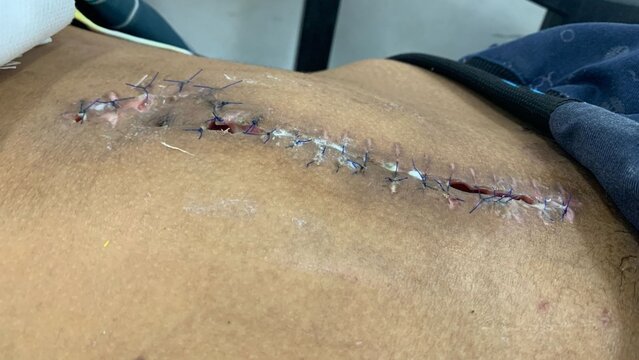 Post-Surgical Laparotomy Wound with Stitches and Infection, exploratory laparotomy operation