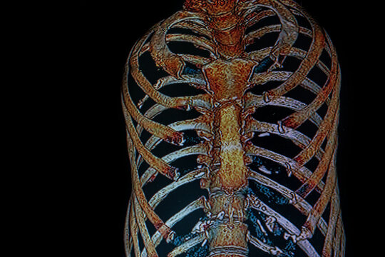 Medical themes:  Right chest CAT- SCAN of patient with broken ribs
