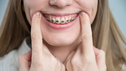 Obraz premium Close-up of a young woman's smile with metal braces on her teeth. Correction of bite