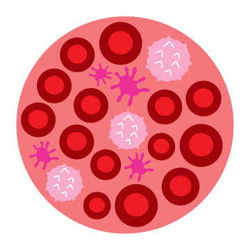 polycythemia vera