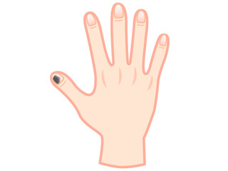 Obraz premium 爪下血腫で内出血した手のイラスト素材2