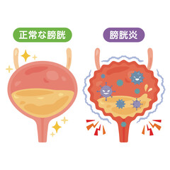 正常な膀胱と膀胱炎のイラスト