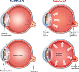 illustration of glaucoma eye diagram