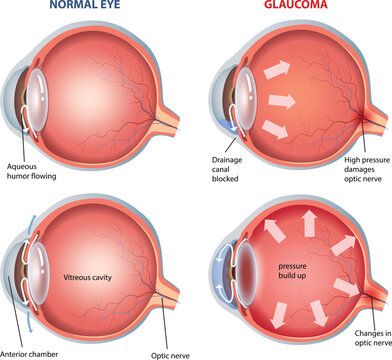 illustration of glaucoma eye diagram