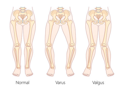 differences between normal leg alignment, varus bowlegged, and valgus knock-knees conditions with skeletal structure diagram hand drawn raster illustration. Medical science educational illustration