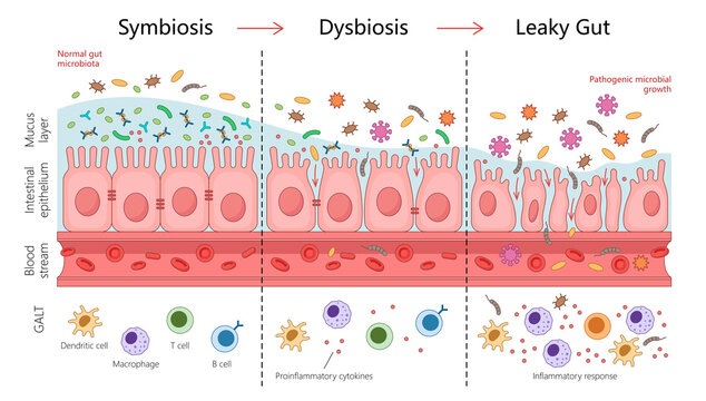 gut health progression from symbiosis to dysbiosis and leaky gut, showing microbiota changes, inflammation, and intestinal permeability diagram hand drawn raster illustration. Medical science