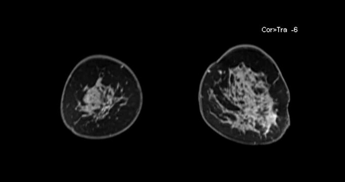 High-resolution MRI breast footage displaying detailed soft tissue structures, aiding in the detection of tumors, cysts, and other abnormalities.