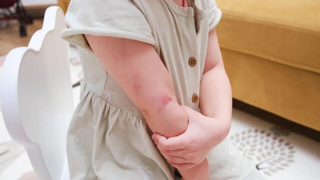A little child girl with an abrasion, bruise and wound on her arm, a child holding a sore hand, injured kid.