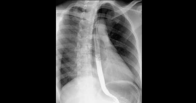 Fluoroscopic footage of a barium swallow test showing real-time esophageal function, used to assess dysphagia, GERD, and structural abnormalities.