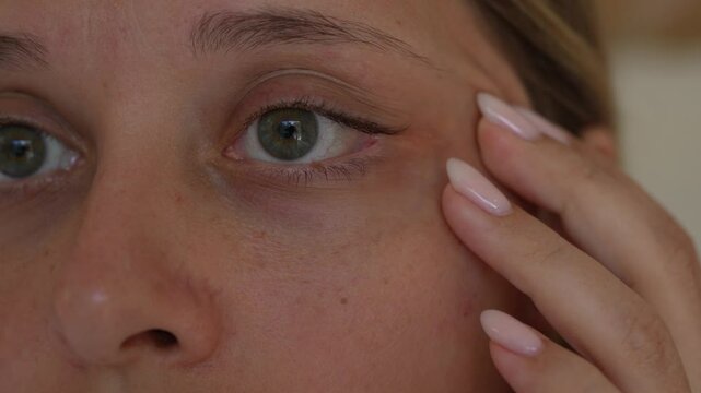 Close-up of a young woman showing a milia (small white cyst) near her eye. Skin condition detail, dermatology concept. Milia treatment, skincare awareness, and natural skin texture