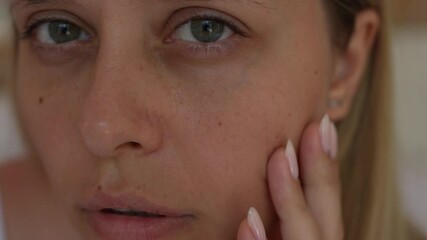 Close-up of a young woman's face showing skin with pigmentation spots caused by sun exposure, hormonal changes, aging, and inflammation. Skincare awareness and treatment options for hyperpigmentation