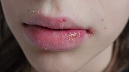 Skin health and healing tips for treating lip sores and irritation effectively