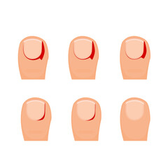 Ingrown Toenail and Nail Infection Vector Illustration