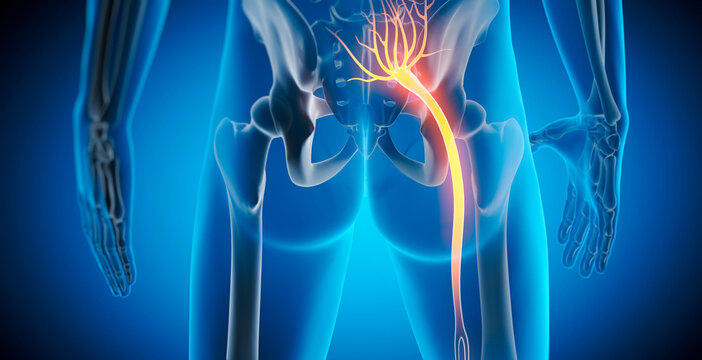 Medically accurate 3D illustration of a painful sciatic nerve cause by injury or irritation