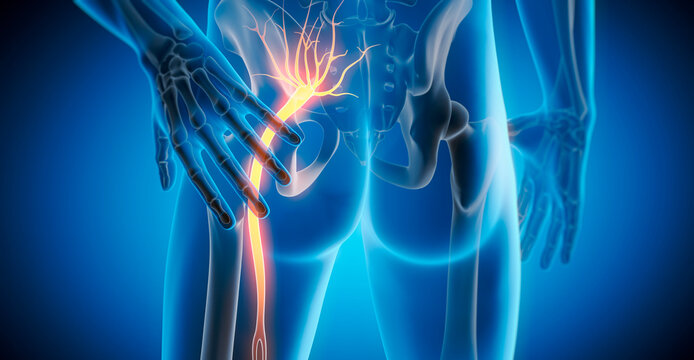 Medically accurate 3D illustration of a painful sciatic nerve cause by injury or irritation