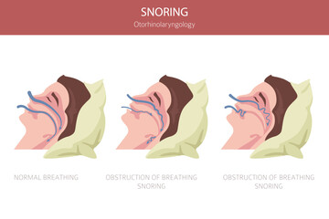 Sleep Apnea diseases. Otorhinolaryngology. Sleep related breathing disorder. Medical infographic design. Vector illustration