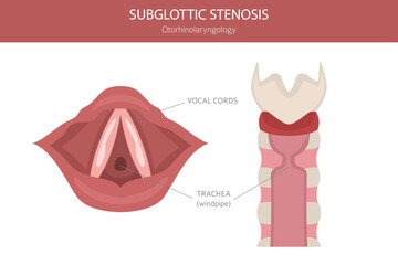 Subglottic Stenosis diseases. Pulmonology, otolaryngology. Medical infographic design. Vector illustration