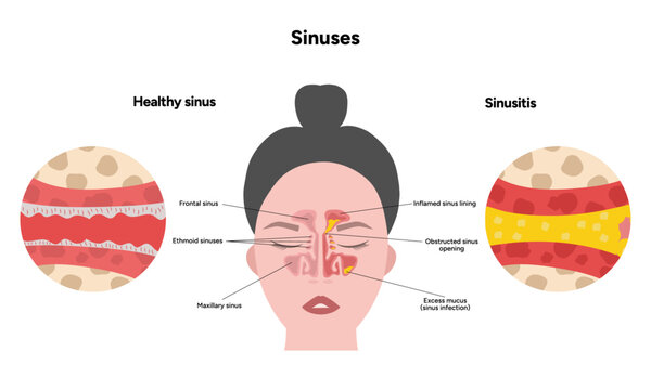 Sinuses anatomy healthy sinus and sinusitis. Nose nasal anatomy. Inflammation Nasal Cavity