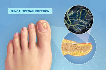 Toenail fungus infection
