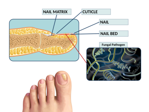 Toenail fungus infection