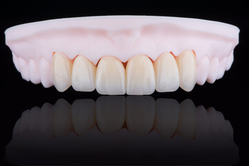 High-quality six dental crowns made of zirconium for fixation to the frontal teeth of upper jaw. © gorynvd