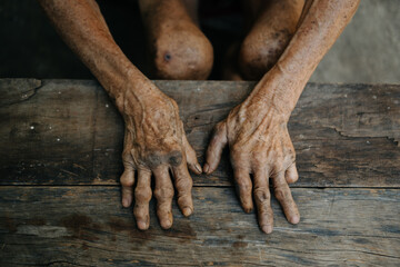 Close up of male wrinkled hands, old man is wearing  skin disease and anxiety Copy space.