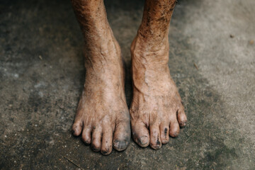 Close up of male wrinkled hands, old man is wearing  skin disease and anxiety Copy space.