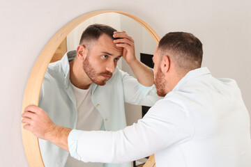 Fototapeta premium Baldness problem. Man with receding hairline near mirror at home