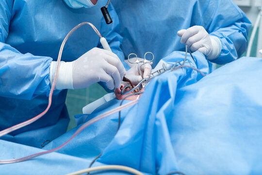 Otolaryngologist performs tonsillectomy, removal of tonsils, ENT. septoplasty, maxillofacial surgery.An array of medical instruments and hoses is visible, indicating a sterile surgical environment. 