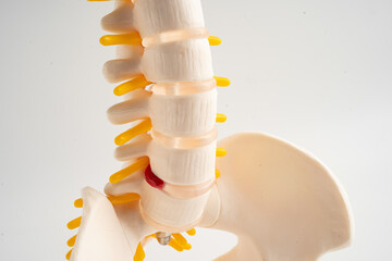 Lumbar spine displaced herniated disc fragment, spinal nerve and bone. Model for treatment medical...