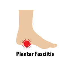 Foot pain illustration, Plantar Fasciitis.