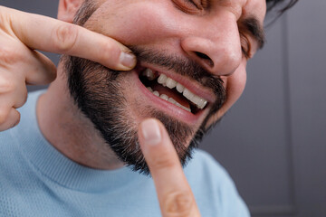 Man smiling and playfully pointing at missing tooth