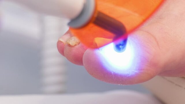 Drying glue with a handheld UV lamp on a big toe nail when installing a 3-toe brace to treat an ingrown toenail. Nail care and podology
