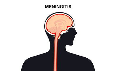 Meningitis medical poster