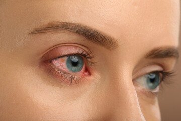 Obraz premium Conjunctivitis. Young woman with bloodshot in eye, closeup