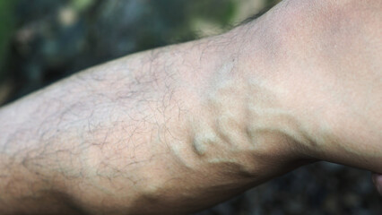 Varicose veins on the legs of men