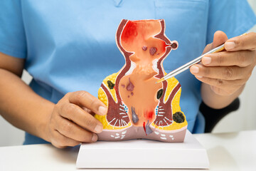 Asian doctor with rectum and hemorrhoid human anatomy model at hospital, inflamed vascular...