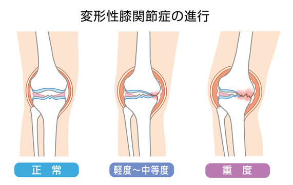 変形性関節症」の写真素材 | 236件の無料イラスト画像 | Adobe Stock