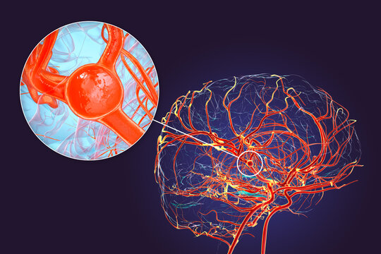 A saccular brain aneurysm, 3D illustration