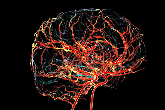 A saccular brain aneurysm, 3D illustration