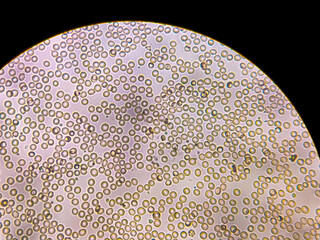 Human blood under a microscope. You can see erythrocytes - red blood cells (RBC).The red color is...