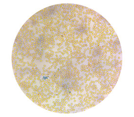 Human blood under a microscope. You can see erythrocytes - red blood cells (RBC).The red color is...