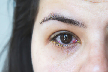 Fototapeta premium Close-up of an infected eye with redness and yellow discharge, symptoms of bacterial conjunctivitis, irritated and swollen look, medical condition, ophthalmology, eye health