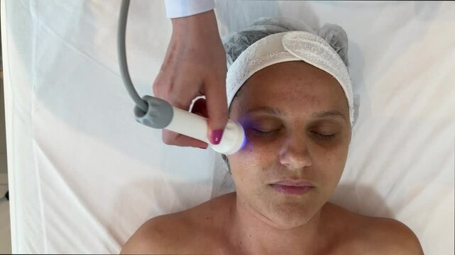 Radiofrequência Facial - Flacidez de pele , rugas e linhas de expressão

